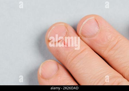 Kleine Wunde am Finger, frisches Blut nach Verletzungen, Nahaufnahme, Blutungen Stockfoto