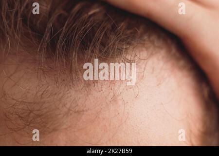 Der kahlen Mann öffnet seine Stirn, Nahaufnahme Stockfoto