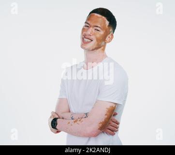 Liebe die Haut in der du bist. Porträtaufnahme eines hübschen jungen Mannes mit Vitiligo, der seine Arme auf weißem Hintergrund geklappt hat. Stockfoto