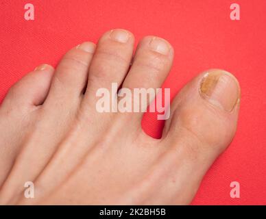 Zehennägel mit Pilzproblemen auf rotem Hintergrund im Nahbereich Stockfoto