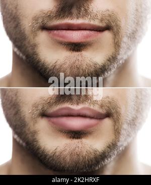 Lippenaugmentation. Männliche Lippen vor und nach der Füllinjektion. Stockfoto