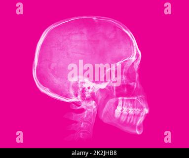 Menschlicher Schädel. Röntgenbild auf pinkfarbenem Hintergrund Stockfoto