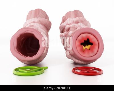 Obstruktive und unobstruktive Bronchialsonden als Zeichen von Asthma. 3D Abbildung Stockfoto