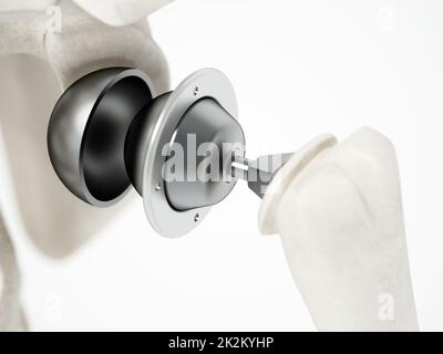 3D Darstellung der Schulterersatzoperation. 3D Abbildung Stockfoto