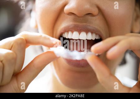 Durchsichtiger Aligner Dental Night Guard Stockfoto