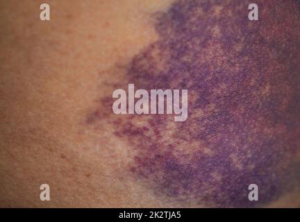 Prellung auf der Gesäßhaut Verletzung durch Unfall zu Hause. Stockfoto