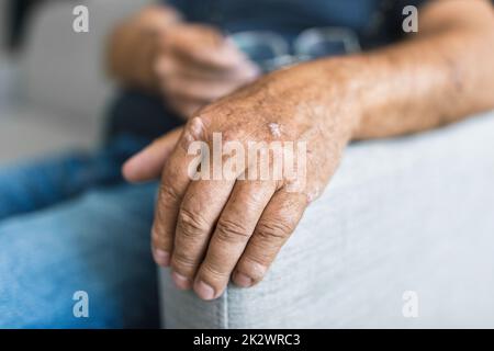 Alter Mann mit Psoriasis an den Händen Stockfoto