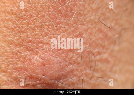 Geschwollene Stichstelle, Rötung auf der Haut durch einen Bienenstich, Nahaufnahme der Stichstelle. Stockfoto