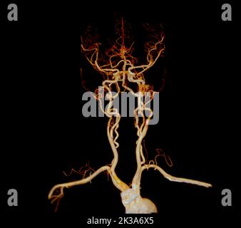 CTA-Gehirn oder CT-Angiographie des Gehirns 3D Rendering-Bild für die Diagnose Hirnarterie Aneurysma. Stockfoto