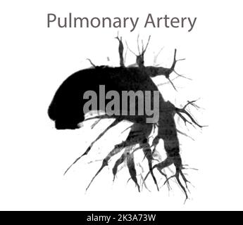 CTA-Pulmonalarterien, die den Ast der Pulmonalarterie zeigen Stockfoto