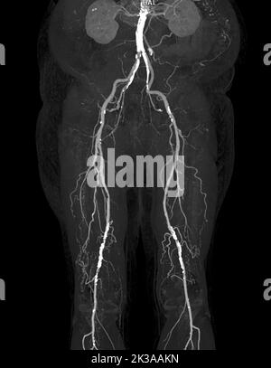 CTA femorale Arterie verlaufende Bild der femoralen Arterie mit akuter oder chronischer peripheraler arterieller Erkrankung. Stockfoto