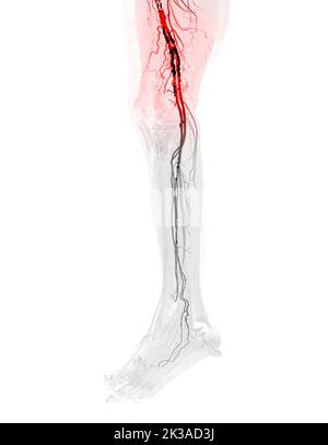 CTA femorale Arterie verlaufende Bild der femoralen Arterie mit akuter oder chronischer peripheraler arterieller Erkrankung. Stockfoto