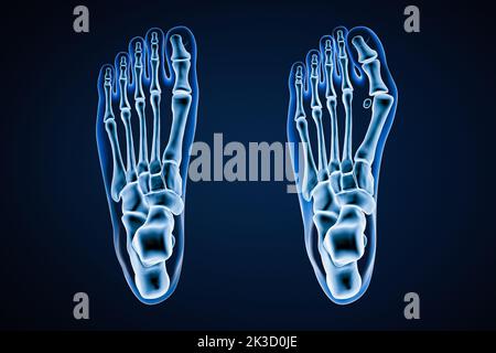 Hallux Valgus oder Bunion x-ray 3D Rendering Illustration. Rückenansicht oder Draufsicht des gesunden und verletzten linken Fußes auf blauem Hintergrund. Anatomie, osteol Stockfoto