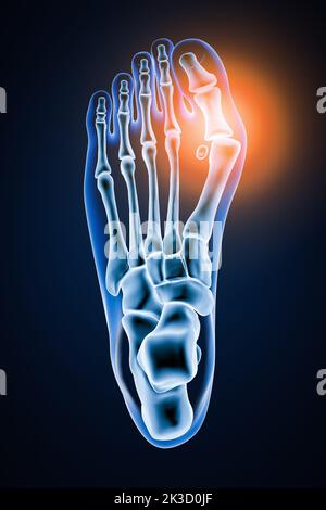 Hallux Valgus oder Bunion 3D Rendering Illustration. Überlegene oder dorsale Ansicht von präzisen menschlichen linken Fußknochen mit Körperkonturen auf blauem Hintergrund. Ein Stockfoto