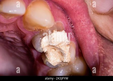 Zahnfüllung mit temporärem Zement zur Wurzelkanalbehandlung. Entfernung von Zahnnerven, Vorbereitung für die Prothetik Stockfoto