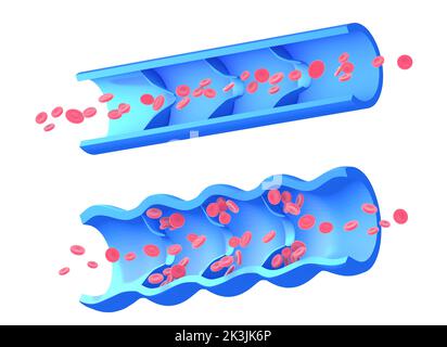 Anatomische 3D Abbildung von zwei Bildern, erkrankte inkompetente Vene und gesunde Vene. Grafische Darstellung des Blutkreislaufs. Stockfoto