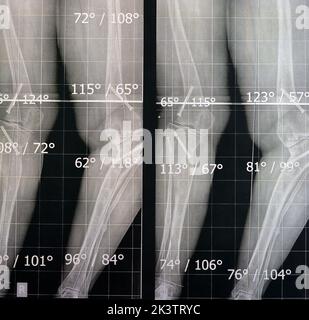 Plain x ray long Film stehende Position zeigt beide Beine mit ...