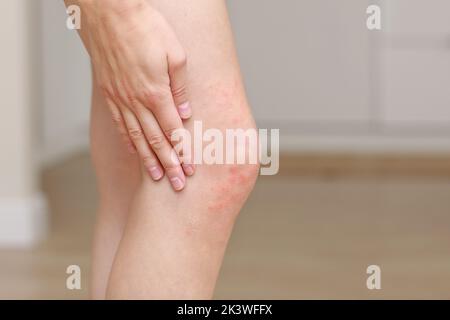 Hautallergien, Beine Haut Frauen. Nahaufnahme von roten Pusteln am Knie, einer allergischen Reaktion, die durch atopische Dermatitis verursacht wird. Ausgewählter Fokus. Stockfoto