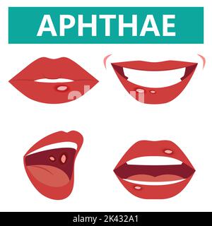 Aphthous Geschwüre auf Mund Nahaufnahme, Vektor-Illustration Cartoon flach Design Clip Art Stock Vektor