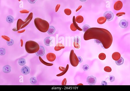 Sichelzellanämie (Sichelzellanämie SCD) Zellen im Blutfluss - isometrische Ansicht 3D Abbildung Stockfoto