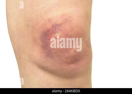 Bluterguss am Knie isoliert auf weißem Hintergrund mit Schnittpfad, verletzte Knie Stockfoto