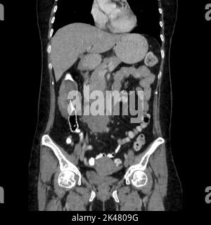 Intsuszeption des Darms, CT-Scan Stockfoto