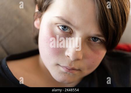 Ein unwohl vorjugendlicher Junge, der auf einer Couch liegt und die Kamera anschaut, seine Wangen sind von einem Fieber rot und er sieht elend aus Stockfoto