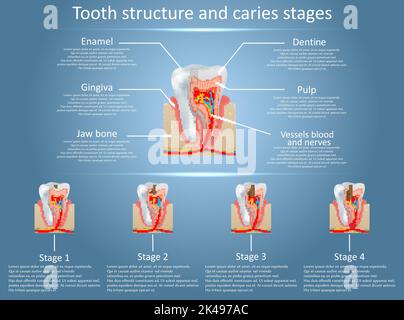 Vektor-Diagramm der menschlichen Zahnstruktur und Kariesstadien. Zahnanatomie und Karies oder Karies Entwicklungskonzept. Ausbildung medizinischer anatomischer Po Stock Vektor