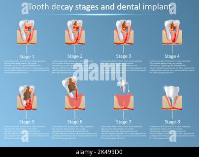 Kariesstadien und Zahnimplantate. Vektorgrafik. Zahnmedizin und Ersatzkonzept. Medizinisches anatomisches Poster zur Schulung. Stock Vektor