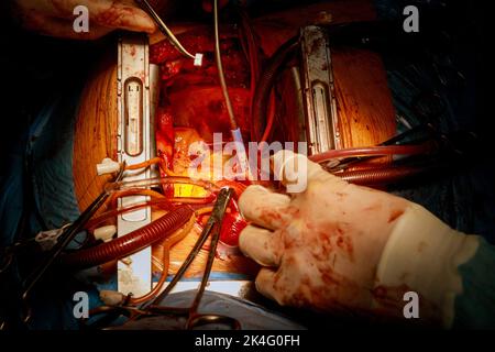 Ein Klappenersatz wird im Operationssaal durchgeführt, wenn eine defekte Herzklappe eine Operation am offenen Herzen verursacht Stockfoto