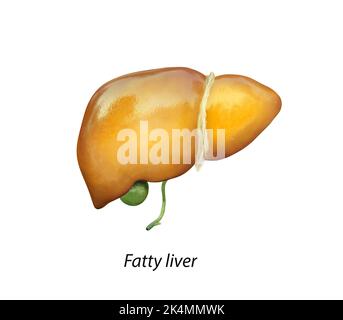 Fettleber, Lebersteatose, tritt es bei Alkoholübergebrauch auf, unter Einwirkung von Giftstoffen, geschädigter Leber, Fettleber, übermäßigem Alkoholkonsum, Behandlung von Männern Stockfoto
