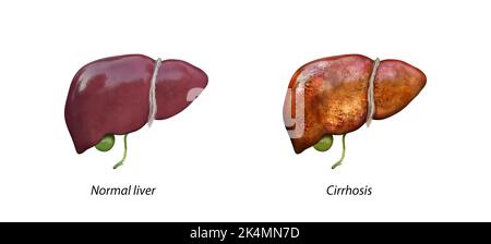 Normale Leber versus Leber mit Zirrhose, geschädigter Leber, übermäßiger Alkoholkonsum, Behandlung, 3D Rendering Stockfoto