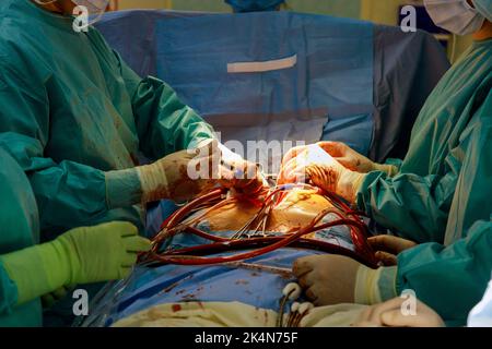 Im Operationssaal des Krankenhauses wird zur Behandlung von Herzerkrankungen aufgrund einer koronaren Herzkrankheit ein Koronararterien-Bypass-Transplantat-CABG durchgeführt. Stockfoto