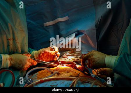 Koronarararterie-Bypass-Transplantat-CABG für Herzoperationen aufgrund einer koronaren Herzkrankheit Stockfoto
