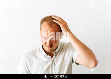 Junger trauriger kahler Mann mit Depressionen bei Haarausfall Probleme, die wütend und frustriert aussehen und seinen Kopf halten. Vor der Haartransplantation Stockfoto