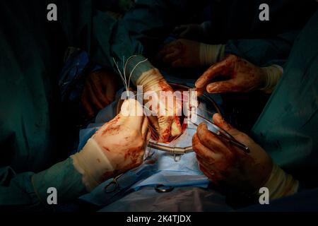 Das CABG-Verfahren für Koronarararterien-Bypass-Transplantate wird für Herzoperationen aufgrund einer koronaren Herzerkrankung im Operationssaal des Krankenhauses durchgeführt Stockfoto