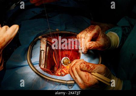 Aufgrund einer Fehlfunktion der Herzklappe führt der Arzt eine Operation am offenen Herzen durch, um die Herzklappe im Operationssaal zu ersetzen Stockfoto