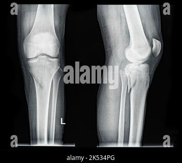 Röntgen-MRT-Bilder zeigen eine echte Fraktur des gebrochenen Beinknochens unter dem Knie nach einer Verletzung Stockfoto