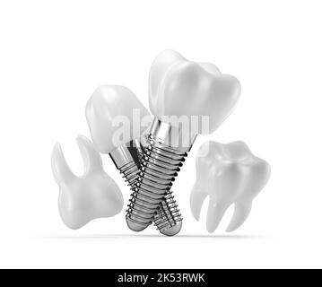 Zahnimplantate isoliert auf weißem Hintergrund. 3D Rendering, 3D Illustration. Stockfoto