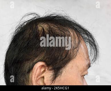 Dünner werdendes oder spärliches Haar, Haarausfall nach männlichem Muster im südostasiatischen, chinesischen älteren Mann. Stockfoto