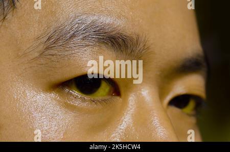 Tiefer Gelbsucht bei einem asiatischen männlichen Patienten. Gelbliche Verfärbung von Haut und Sklera. Hyperbilirubinämie. Akute Hepatitis. Stockfoto