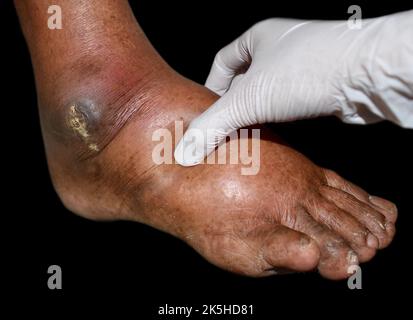 Lochfraß-Ödem der unteren Extremität. Geschwollenes Bein eines alten asiatischen Mannes. Stockfoto