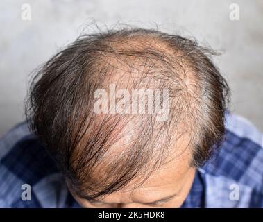 Dünner werdendes oder spärliches Haar, Haarausfall nach männlichem Muster im südostasiatischen, chinesischen älteren Mann. Stockfoto