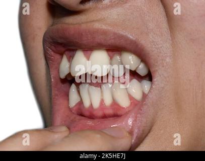 Gestapelte oder überlappende weiße Zähne des asiatischen Mannes. Auch gedrängte Zähne genannt. Stockfoto