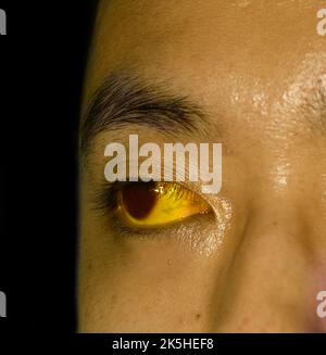 Tiefer Gelbsucht bei einem asiatischen männlichen Patienten. Gelbliche Verfärbung von Haut und Sklera. Hyperbilirubinämie. Akute Hepatitis. Stockfoto