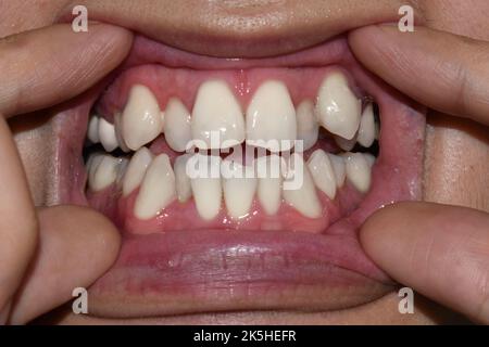 Gestapelte oder überlappende weiße Zähne des asiatischen Mannes. Auch gedrängte Zähne genannt. Stockfoto