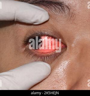 Hornhautinfektion oder Geschwulst genannt Keratitis bei asiatischen jungen Mann. Stockfoto