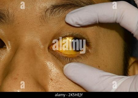 Tiefer Gelbsucht bei einem asiatischen männlichen Patienten. Gelbliche Verfärbung von Haut und Sklera. Hyperbilirubinämie. Akute Hepatitis. Stockfoto