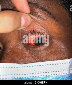 Hornhautinfektion oder Ulkus genannt Keratitis bei der asiatischen alten Frau. Stockfoto