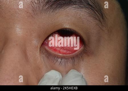 Hornhautinfektion oder Geschwulst genannt Keratitis bei asiatischen jungen Mann. Stockfoto